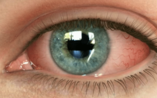 用紫外线灯照在眼睛上的 Izgaryans：治疗和可能的后果